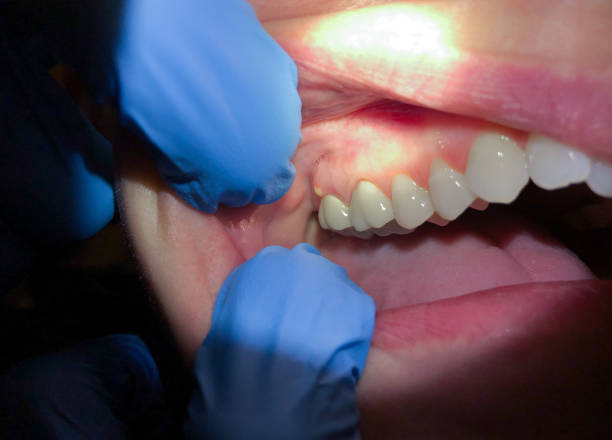 Best Emergency Treatment for Oral Infections in Henry, IL